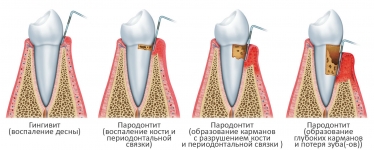 Степени тяжести пародонтита