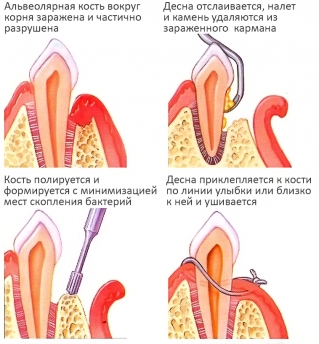 Этапы открытого кюретажа пародонтальных карманов.