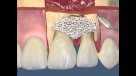 Лоскутная операция с применением костнозамещающих материалов