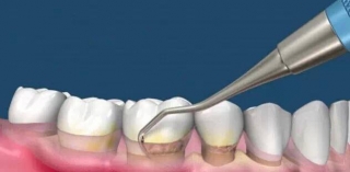 Очистка зубо-десневых карманов механическим способом. Широко применяют и ультразвуковую чистку