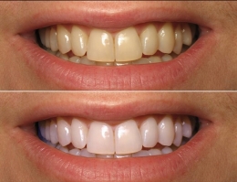 whitening11alaser