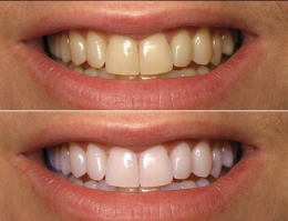 whitening11alaser