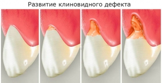 Клиновидный дефект начинается с небольшого "скола" около десны и может превратиться в "большую проблему"