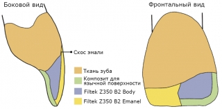 При реставрациях применяют различные композиты для замещения разных тканей, которые отличаются по цвету