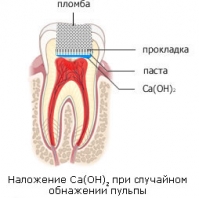 Полное сохранение пульпы