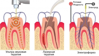 Физиотерапевтические методы лечения пульпита