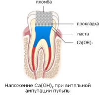 pulpitis_treathment03with_partial_pulp_extraction