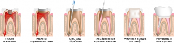 Основные этапы лечения пульпита