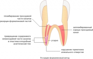 Обтурация корневых каналов резорцин-формалиновой пастой