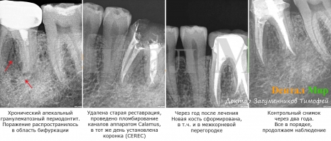 Хронический апекальный гранулематозный периодонтит. Лечение проводилось под микроскопом, применялся аппарат обтурации каналов жидкой гуттаперчей Calamus