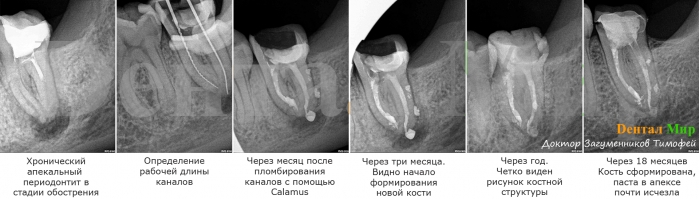 Хронический апекальный периодонтит в стадии обострения. Проведено пломбирование каналов лечебной пастой abscess remedy, чрез одну неделю повторная обработка и пломбирование аппаратом Calamus