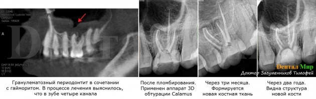 Гайморит и периодонтит гранулематозный. С помощью микроскопа был обнаружен 4й корневой канал. В результате оба заболевания были вылечены