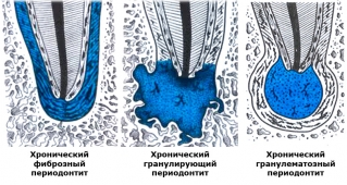 Развитие некоторых видов периодонтита в классификации по Лукомскому