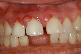 Возможные внешние проявления периодонтитаВозможные внешние проявления периодонтита ("шишка" на десне)