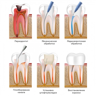 Основные этапы лечения периодонтита. Некоторые не показаны