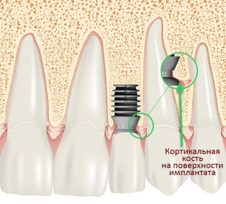 Кортикальная кость на торце имплантата Bicon