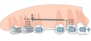 Ортодонтические микроимплантаты