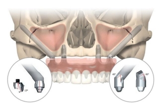 Скуловые имплантаты Nobel Zygoma