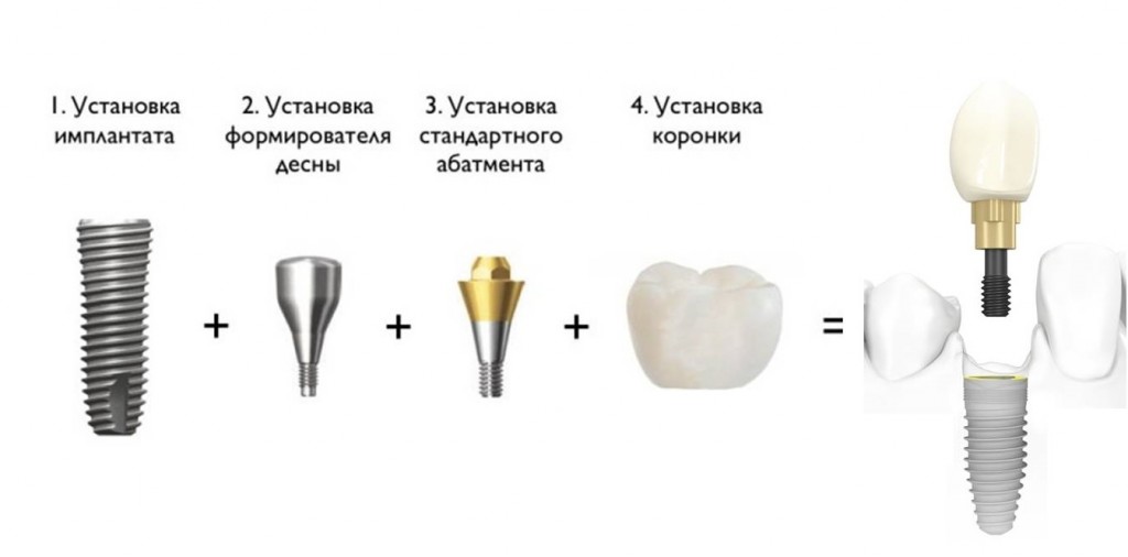 Протезирование на винтовых имплантатах