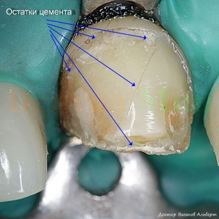 На поверхности зуба под отклеившемся виниром видны остатки цемента