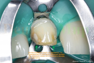 Пигментированная эмаль не удаляется. Этот край необходимо оставить для совмещения отклеившегося винира с зубом