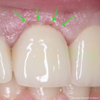 Винир после фиксации. Слегка поврежденная десна восстановится в течение дня