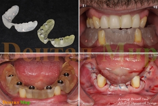 Выставление прикуса и фотография с РК шаблоном, имплантация