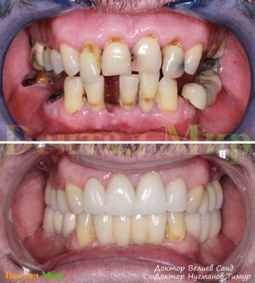 Фотография до и после лечения