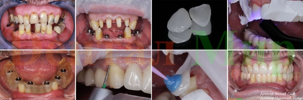 Обзорная фотография работы. Имплантация, установка коронок и виниров