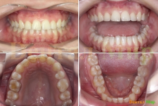 Диагностические фотографии полости рта. Фронтальные и окклюзионные