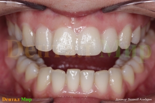 MockUp - предварительная модель зубов в полости рта