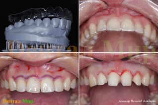 Коррекция контура десны и препарирование