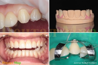 После препарирования, виниры на модели и их фиксация