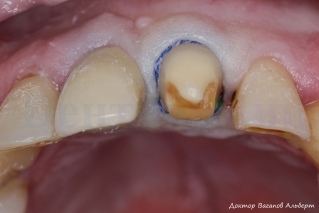 Зуб после препарирования. Ретракционная нить установлена