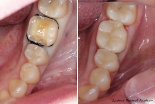 Фотография зуб до и после установки керамической накладки