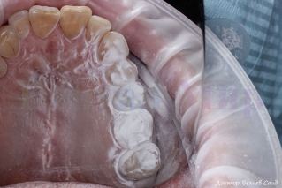 Покрытие зубов специальным порошком перед сканированием