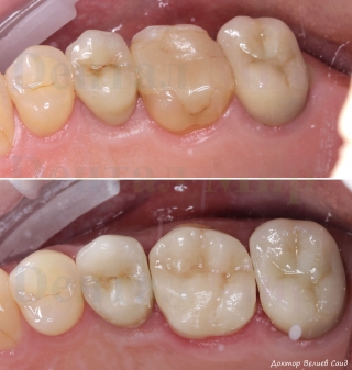До и после лечения. Изготовлена накладка On-lay по технологии CEREC