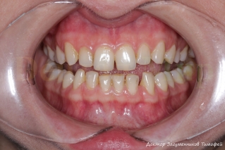 Фотография зубов начальной ситуации с ретрактором