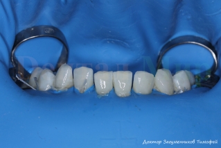 Изоляция нижних зубов с помощью коффердама