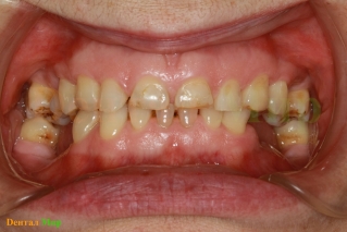 Отсутствующие зубы стали причиной "занижения" прикуса и повышенной истираемости зубов
