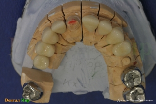 Постоянные коронки на моделях. Верхняя челюсть