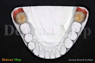 По прошествии нескольких месяцев, изготавливаются постоянные коронки на нижнюю челюсть