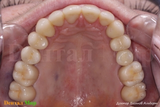 Итоговая работа, верхняя челюсть окклюзионное фото