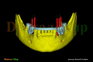 Предварительное планирование операции по имплантации зубов