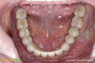 Окклюзионное фото НЧ после лечения