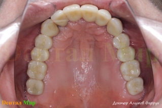 Окклюзионное фото ВЧ после лечения