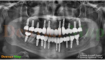 Снимок ОПТГ после лечения - имплантации и протезирования