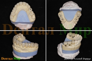 Керамические коронки на моделях