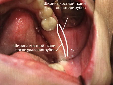 Атрофия костной такани