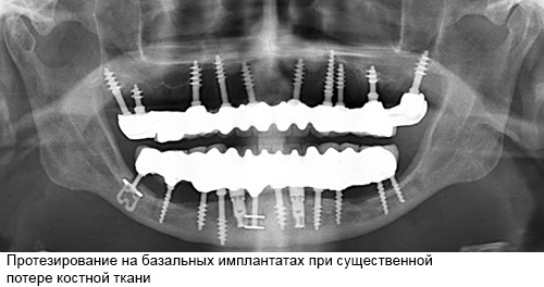 Полное протезирование с помощью базальных имплантатов